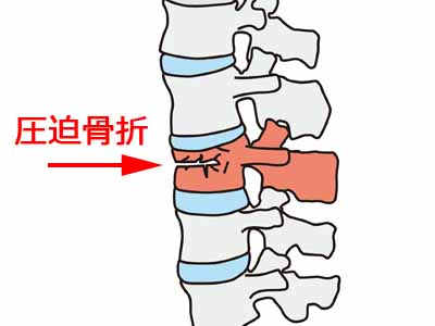 脊柱管狭窄症　圧迫骨折